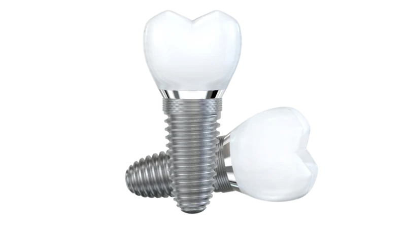 Exosome Therapy for Dental Implants: Does It Help?
