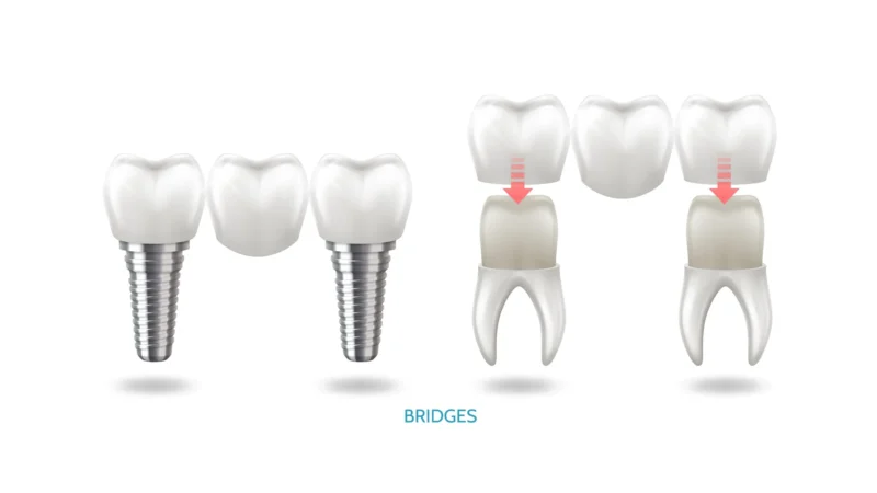 Dental Bridge vs Implant: Which Tooth Replacement Is Better in 2026?
