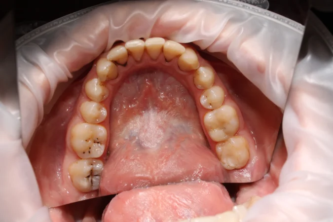 How to Fix Tooth Decay: Treatment and Prevention