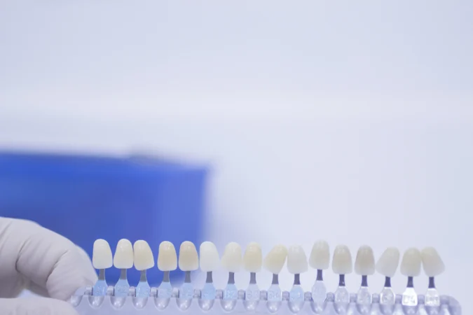 Veneers vs Crowns: A Dentist’s Honest Comparison