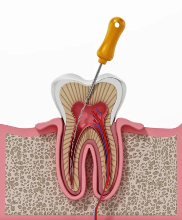 Apicoectomy (Apicectomy / Root-End Surgery): What It Is, Success Rates & Cost
