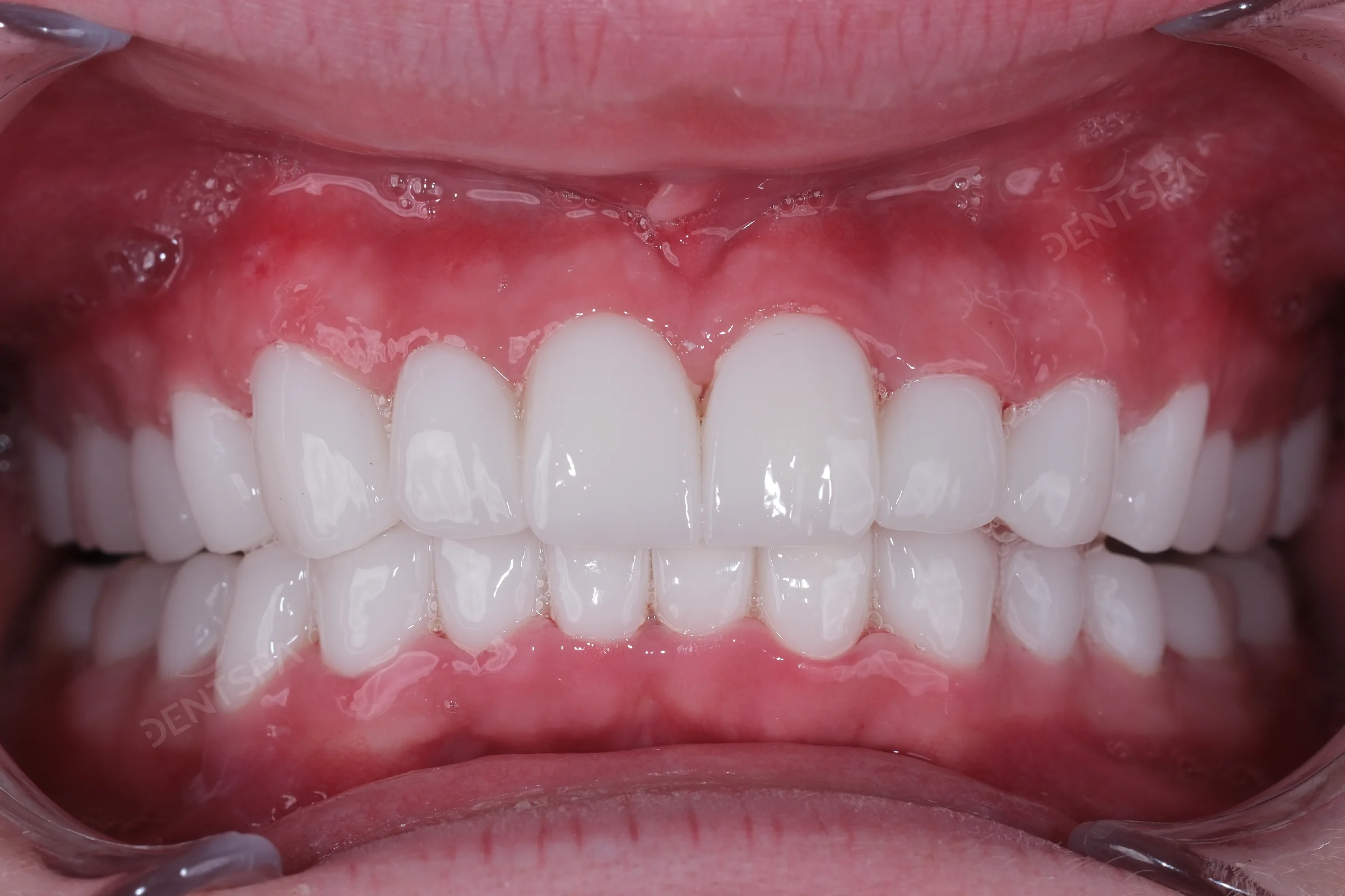 After Hollywood smile veneers at DentSpa
