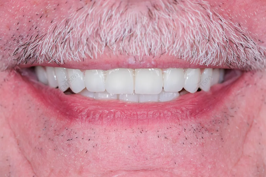 After: full veneer Hollywood smile at DentSpa