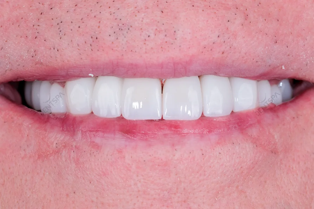 After Hollywood smile makeover at DentSpa