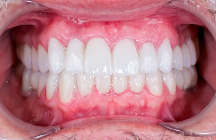After Hollywood smile: bright, even veneers at DentSpa