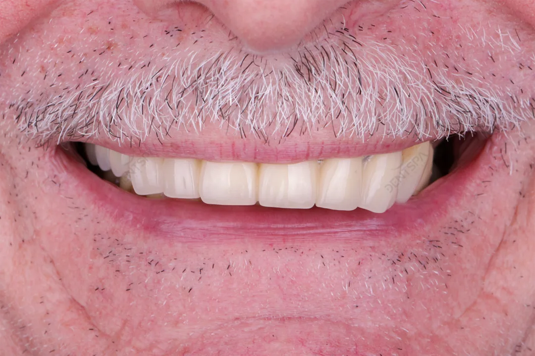 Before: worn teeth before Hollywood smile at DentSpa