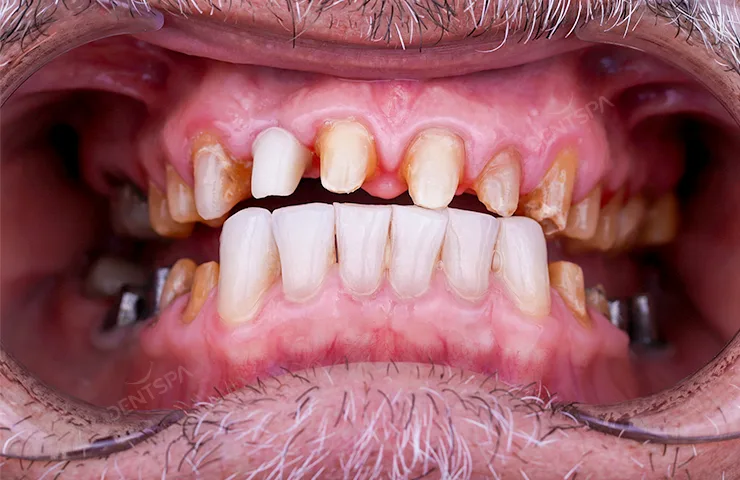 Before Hollywood smile: uneven, discolored teeth at DentSpa