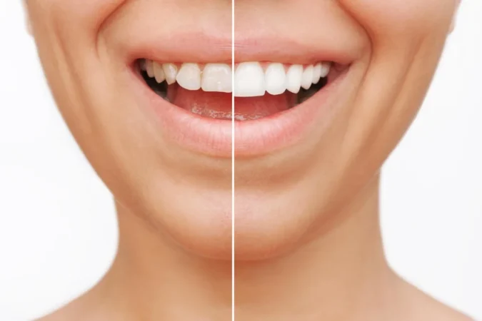 Veneers: Wie viel Zahnsubstanz wirklich abgetragen wird