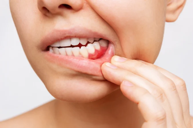 Déchaussement des dents : causes, signes et comment l&rsquo;arrêter