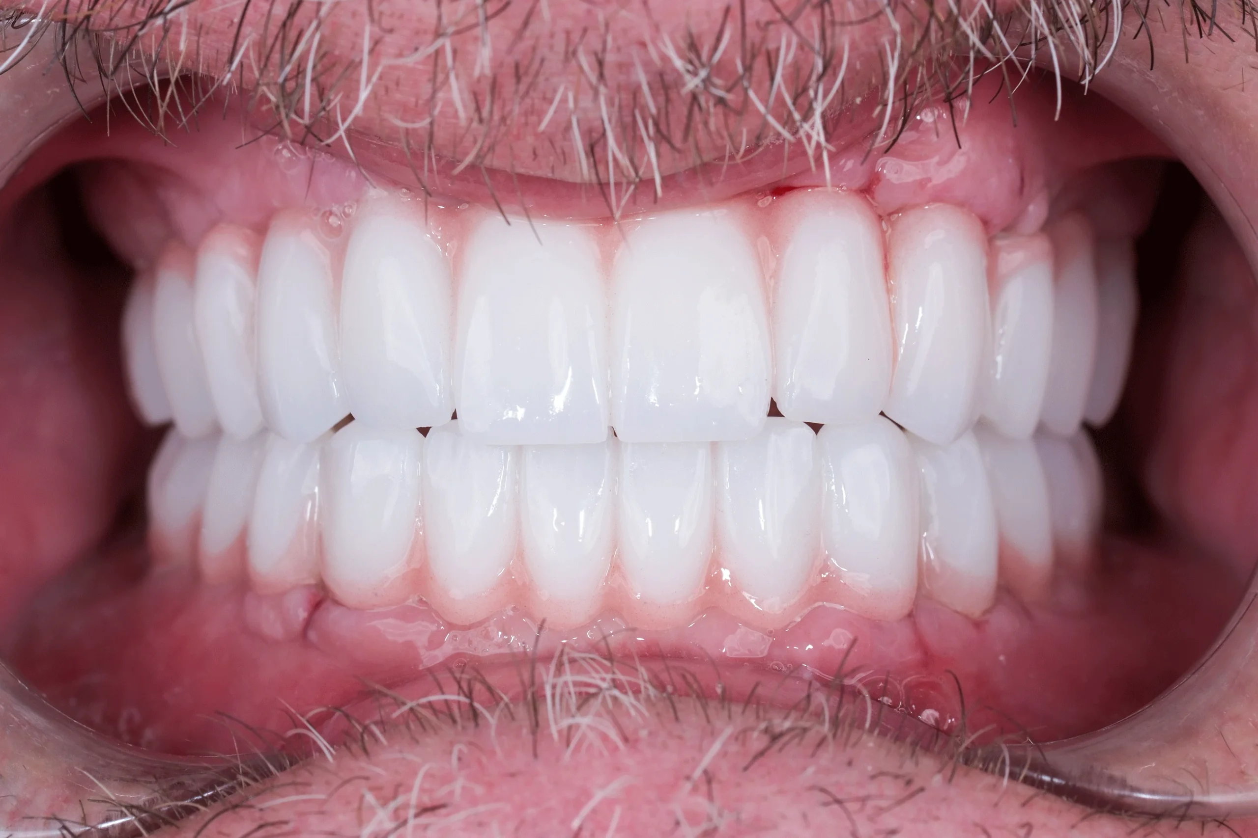 Remplacement de plusieurs dents manquantes, avant et après, chez DentSpa 