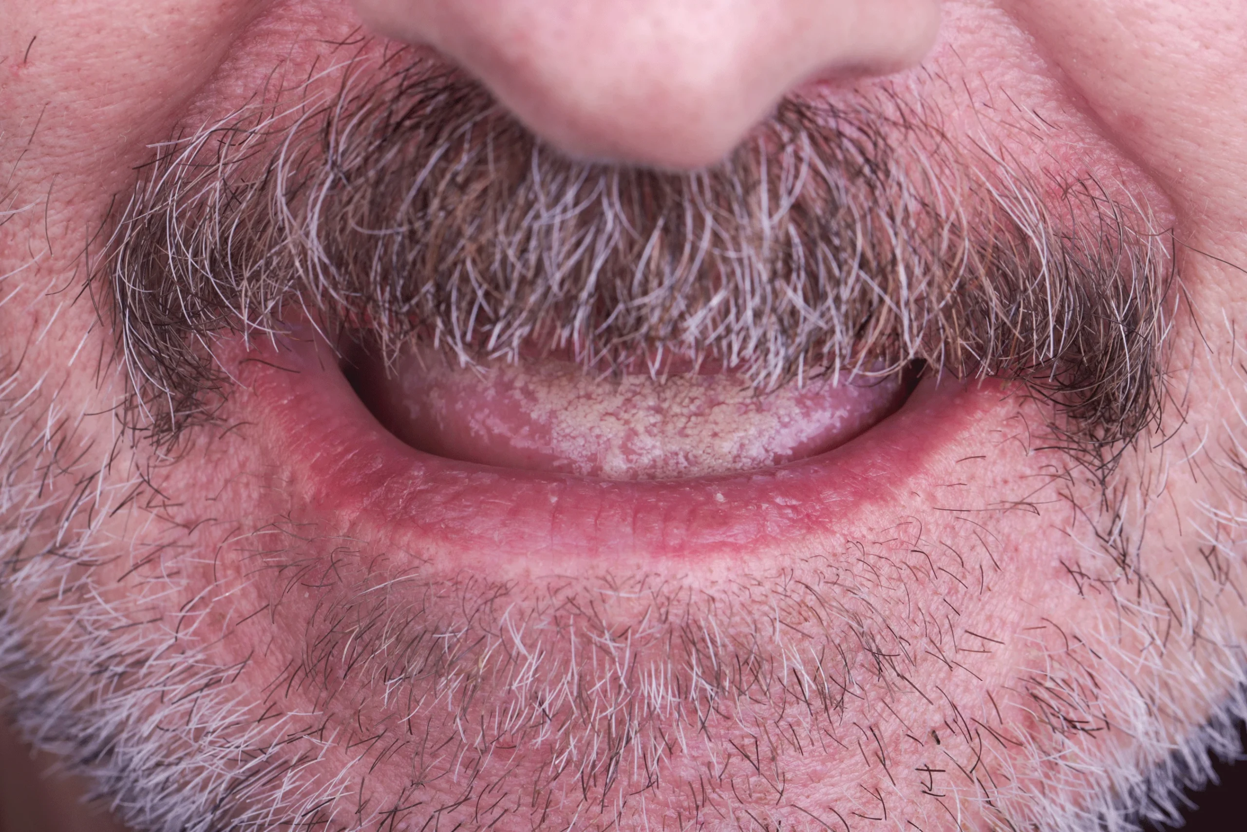 Remplacement de plusieurs dents manquantes, avant et après, chez DentSpa 