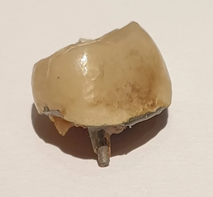 Couronne dentaire qui s'est décollée de la dent, avec le tenon encore visible sous la couronne