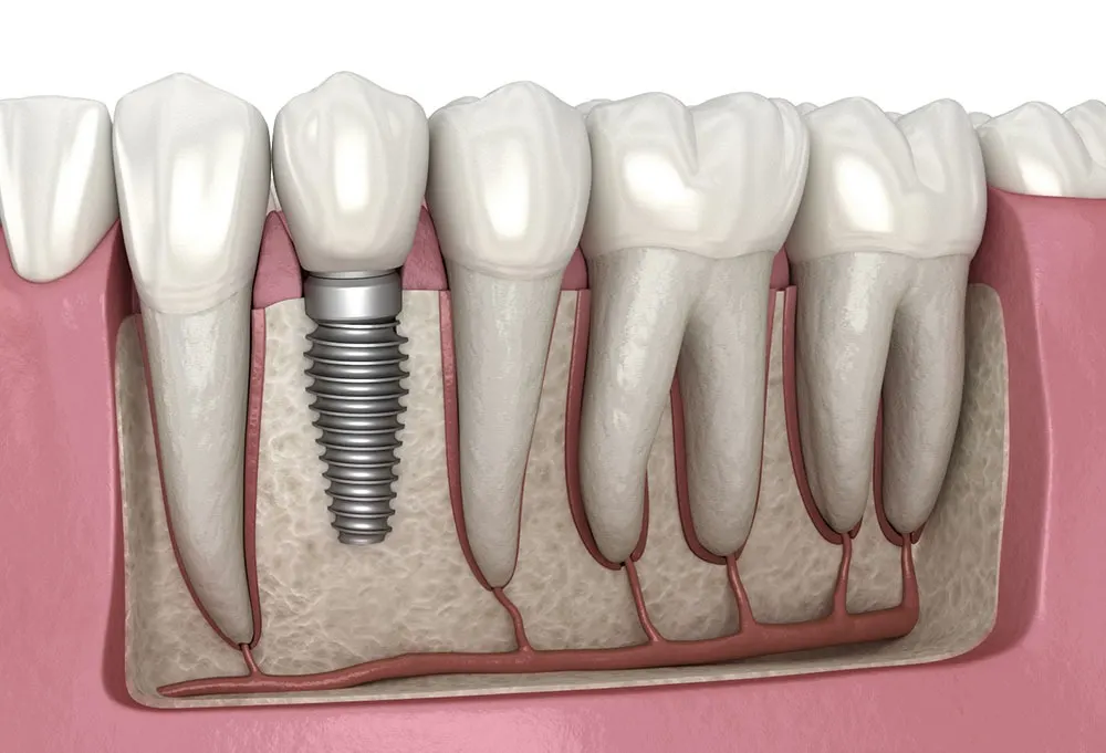 Implant dentaire dans l'os de la mâchoire, avec le pilier et la couronne vissés au-dessus, entre des dents naturelles