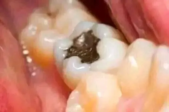 Molaire avec une carie noire au centre de la face de mastication