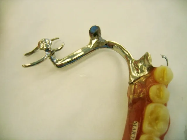 Prothèse partielle à châssis métallique (stellite) avec ses crochets et les dents artificielles sur une base rose