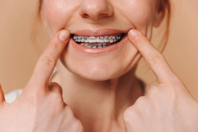 Braces Cost UK: What You’ll Actually Pay in 2026