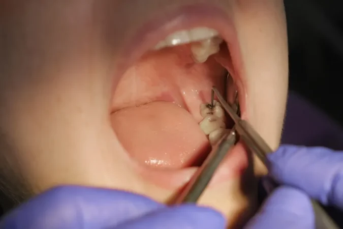 Dent pourrie : causes, symptômes et comment soigner des dents pourries