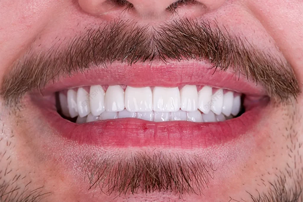 the patient teeth after veneers 