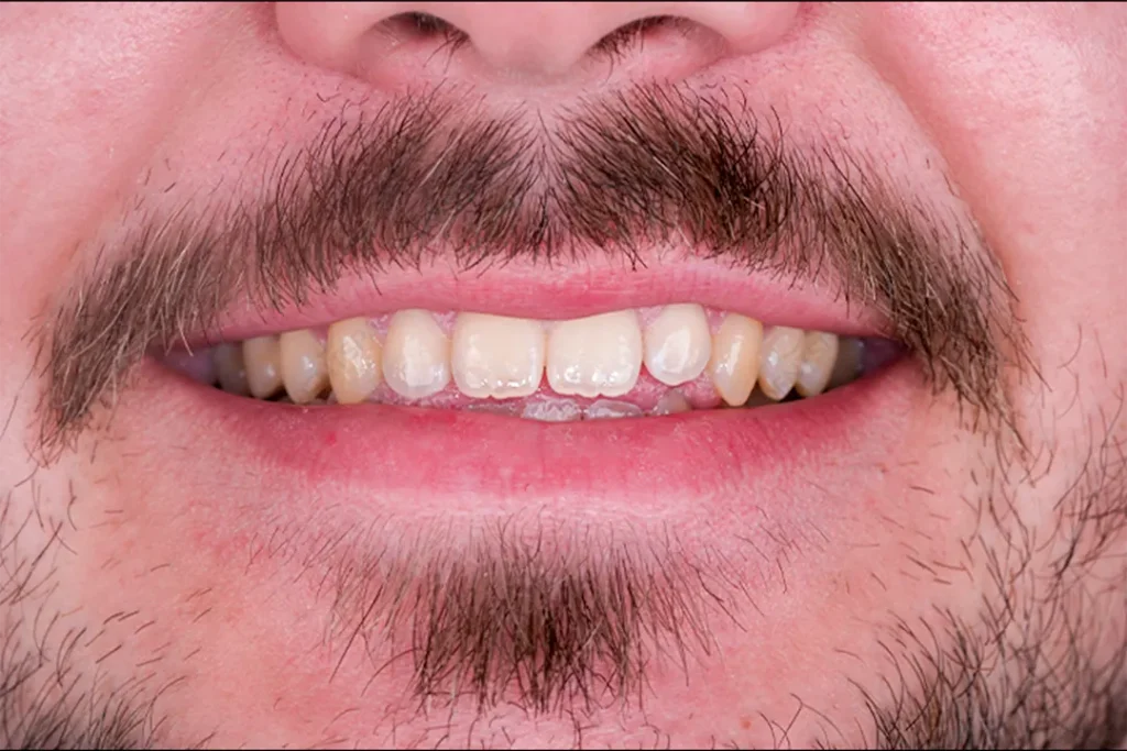 the patient teeth before veneers 