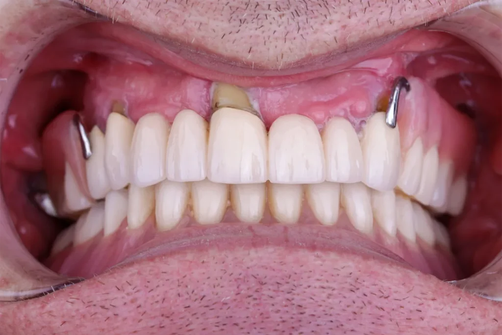 Vorher und nachher: Zahnimplantat bei DentSpa in Istanbul