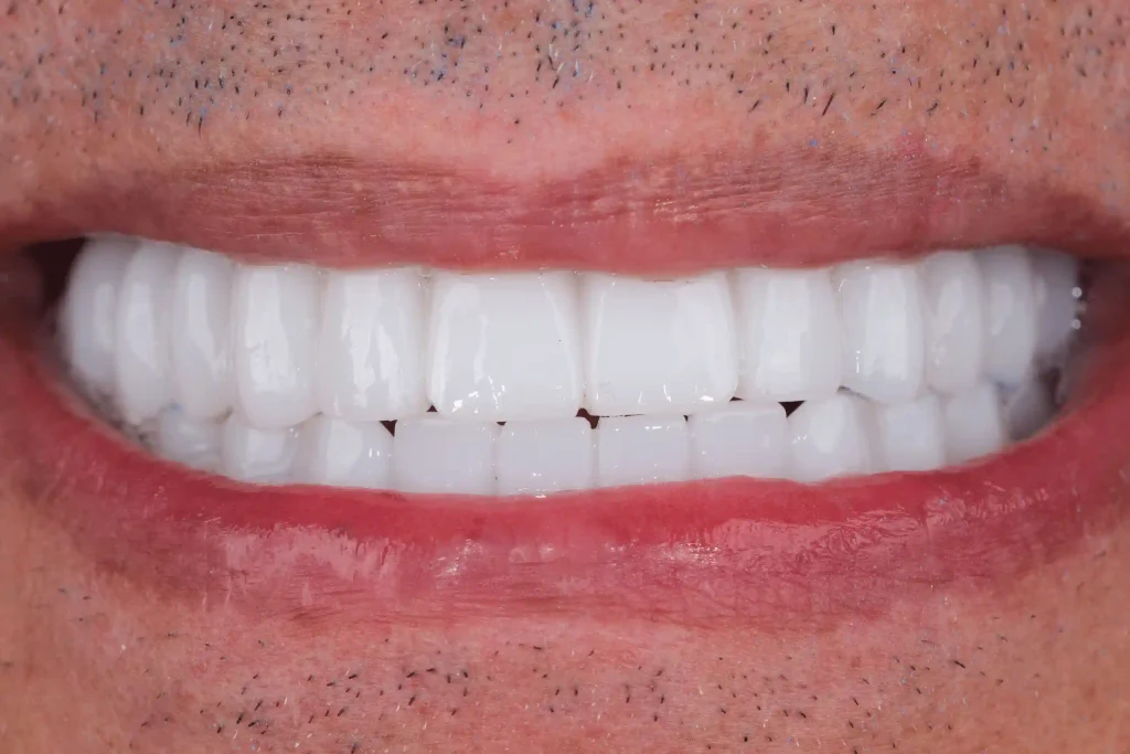 Before and after a single dental implant placed at DentSpa in Istanbul