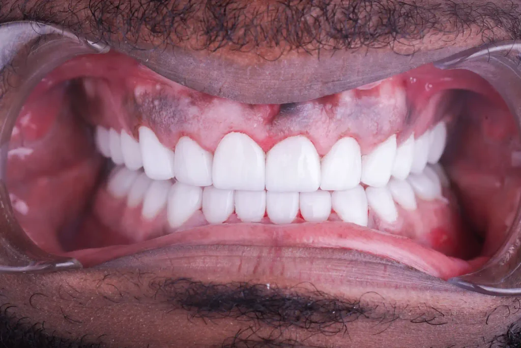 Gums before and after gum disease treatment at DentSpa in Istanbul