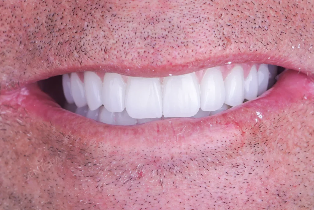 Avant et après : prothèse fixe sur implants chez DentSpa à Istanbul