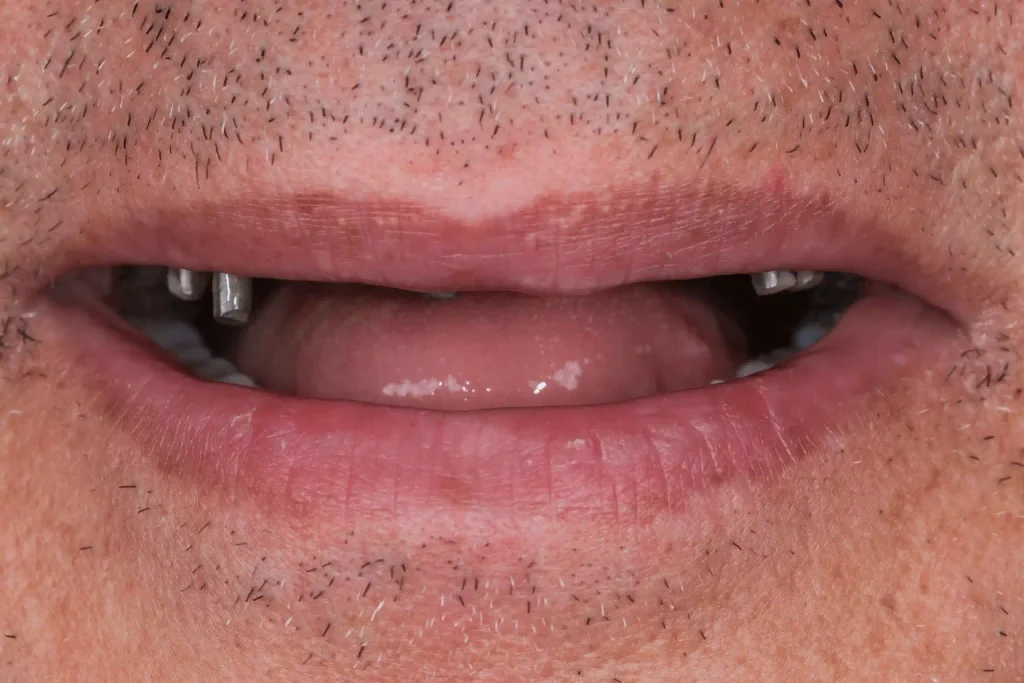 Before and after a single dental implant placed at DentSpa in Istanbul