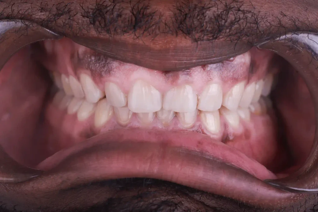 Gums before and after gum disease treatment at DentSpa in Istanbul