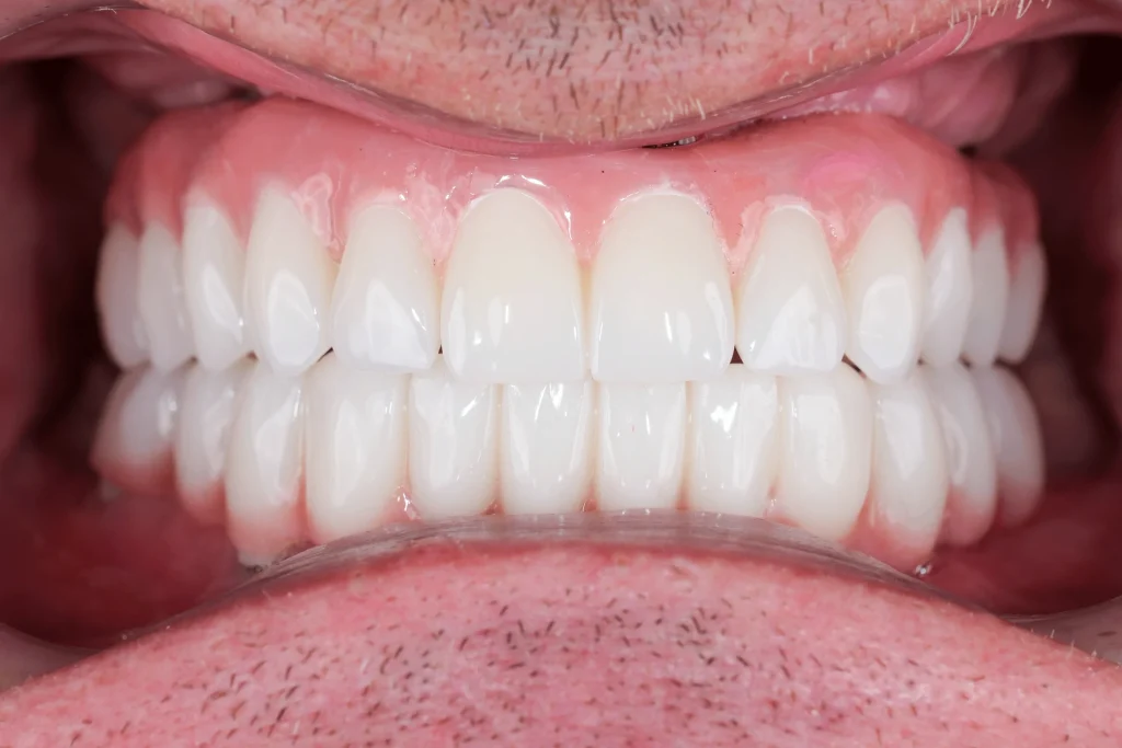 Vorher und nachher: Zahnimplantat bei DentSpa in Istanbul