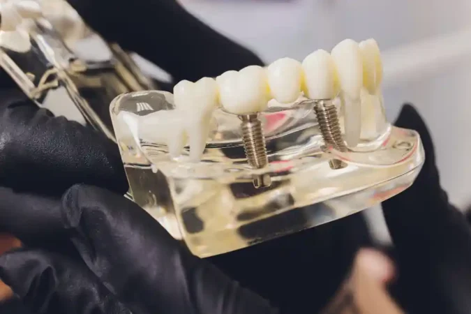Dental Implants Cost UK: What You’ll Actually Pay