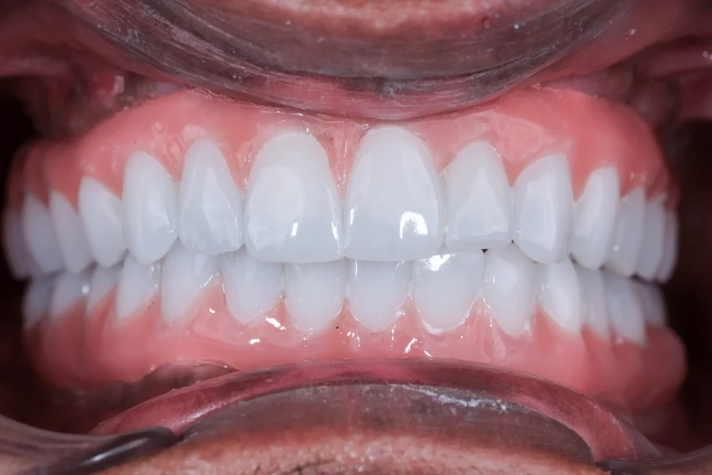 Vorher und nachher: Zahnimplantat bei DentSpa in Istanbul