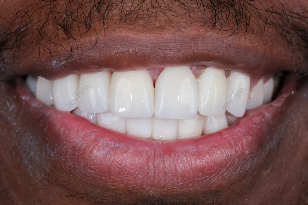 Avant et après : dents usées restaurées par des couronnes chez DentSpa à Istanbul