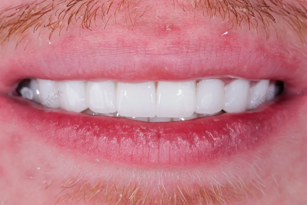 Smile after Hollywood smile treatment with bright, even white teeth.
