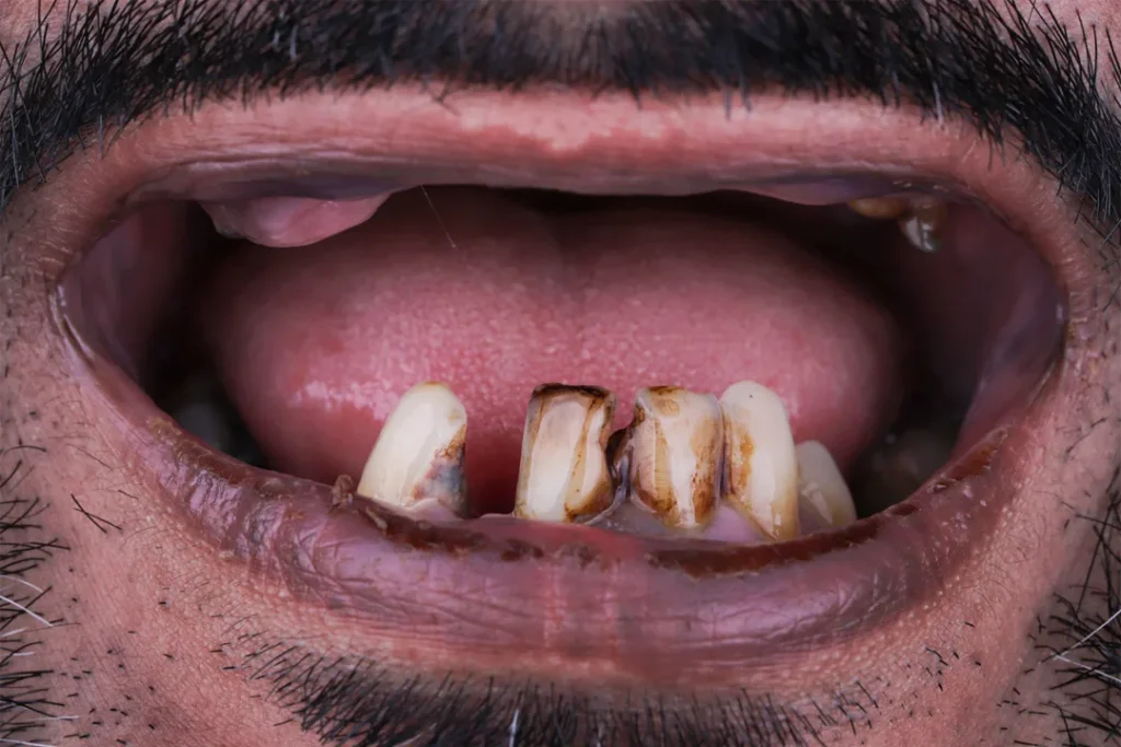 Vorher und nachher: Zahnimplantat bei DentSpa in Istanbul