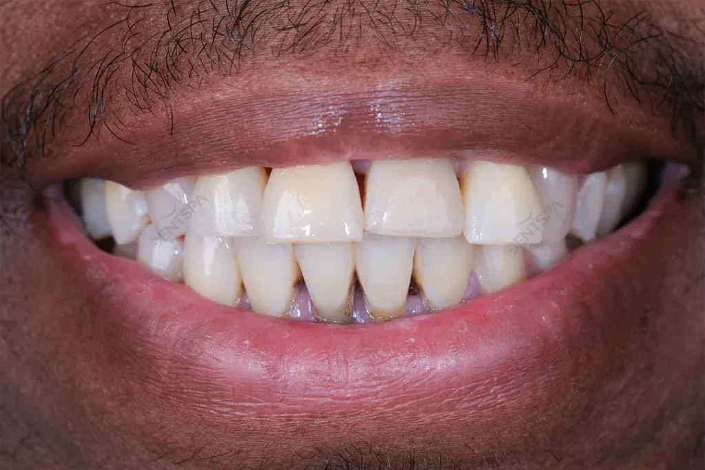 Avant et après : dents usées restaurées par des couronnes chez DentSpa à Istanbul