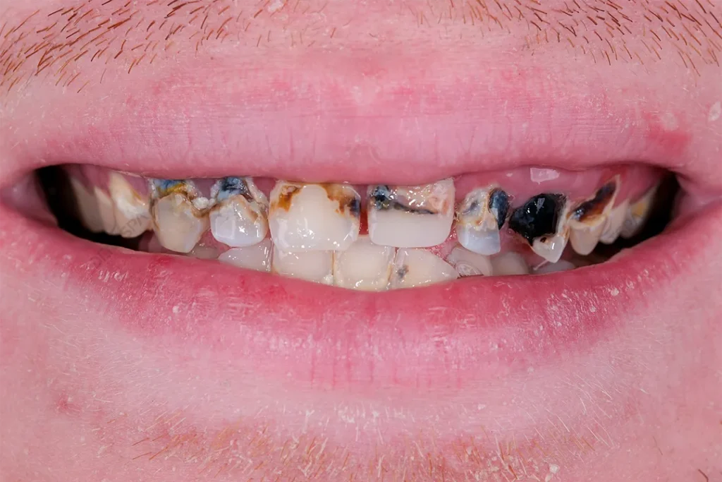 Smile before Hollywood smile treatment with decayed, discolored teeth.