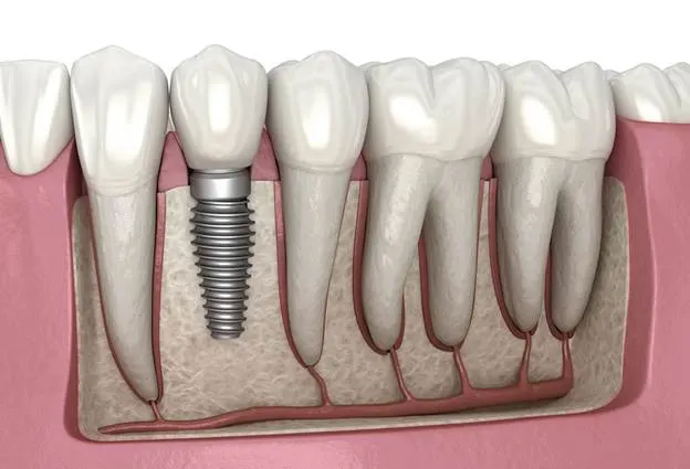 Dental implant in the jawbone between natural teeth, with the crown fitted on top