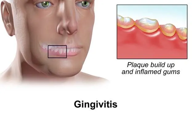 Gingivitis: plaque build-up along the gum line and inflamed gums