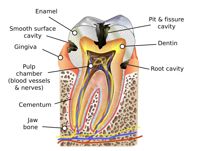 Diagram of a molar cross-section showing enamel, dentin, pulp, and three types of cavities.