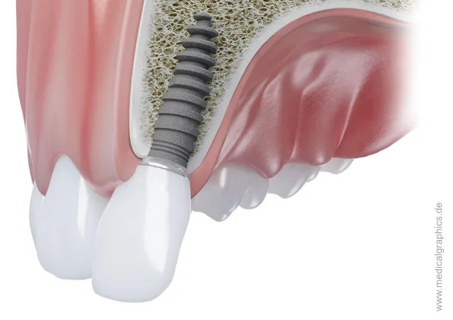 A dental implant replacing an upper front tooth